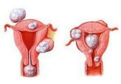 确诊子宫肌瘤的方法